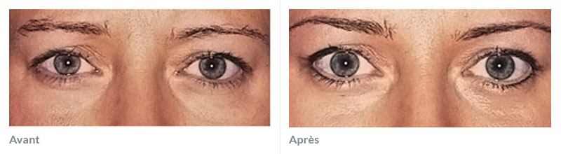 Maquillage permanent yeux avant après 2